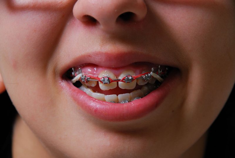 Get Implants in Summit NJ To Replace Missing Teeth