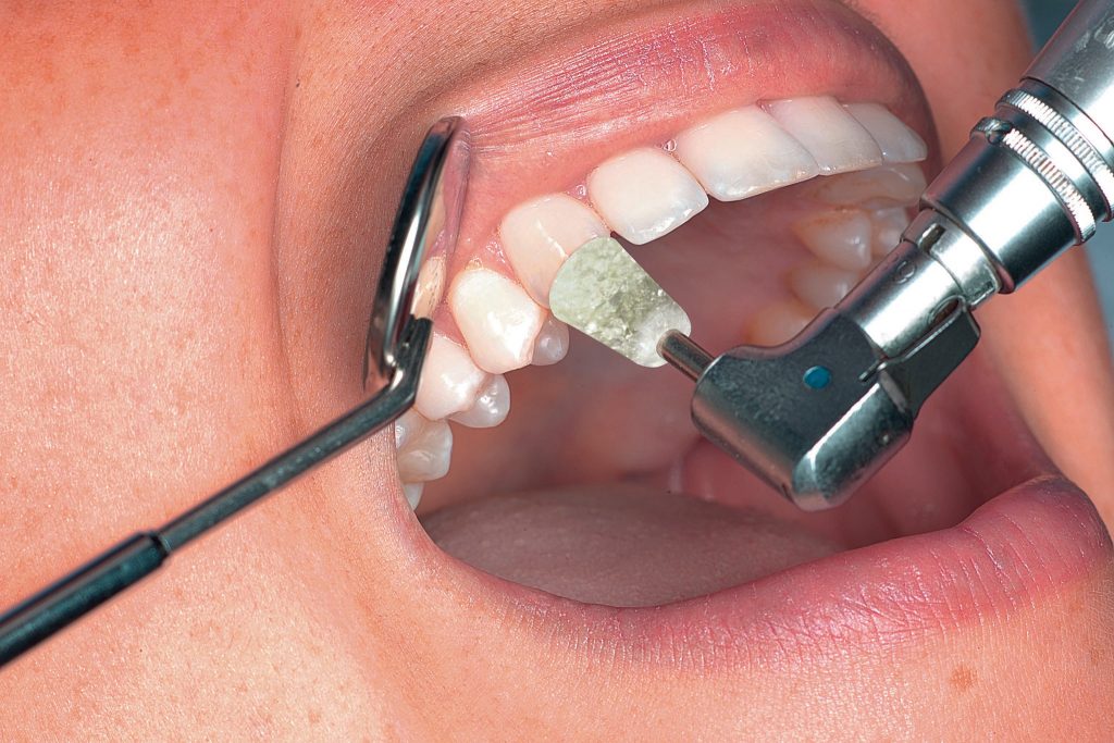 To Glaze or to Polish? Why Dental Polishers Today Are Better Than Ever