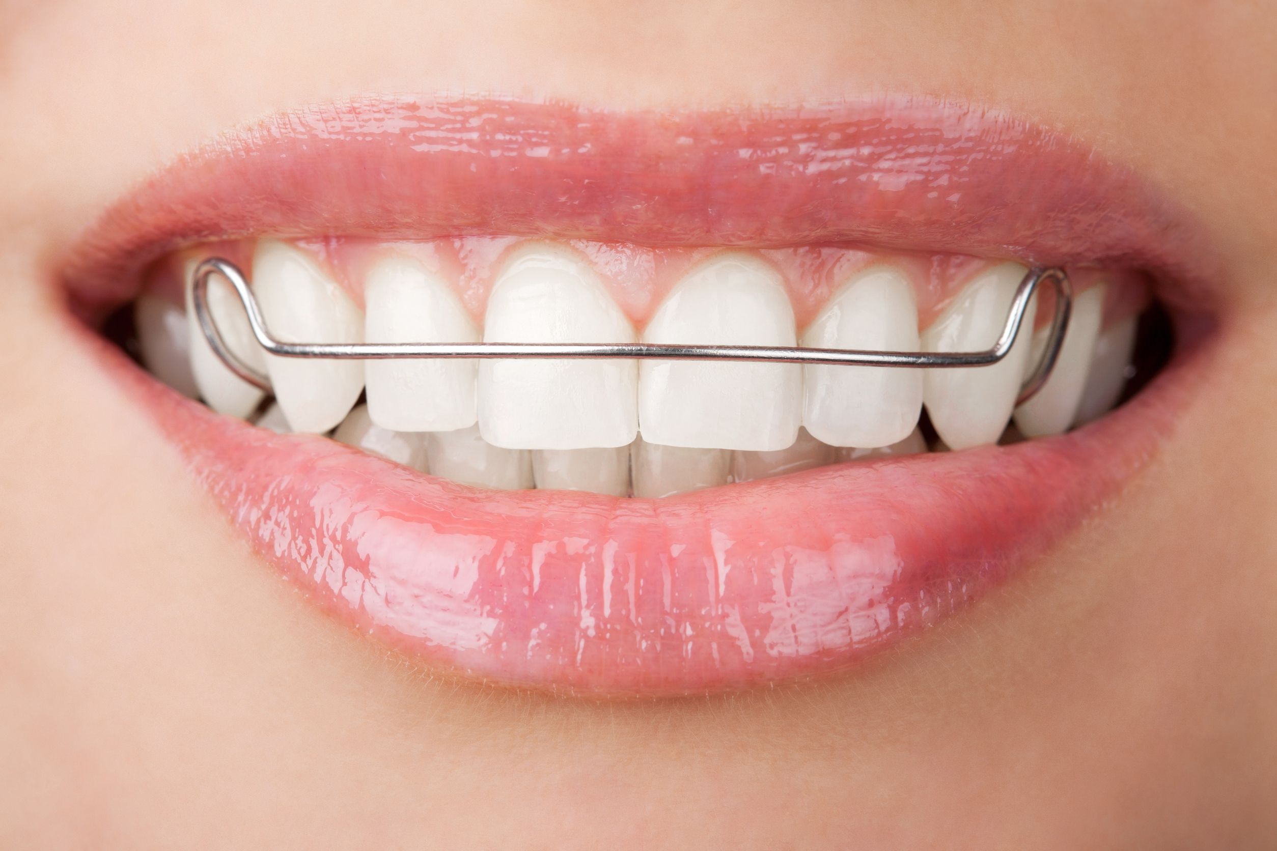 The Health Benefits of Dental Braces in Oxnard, CA