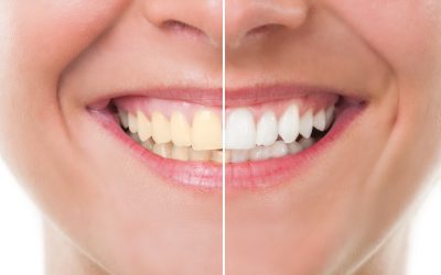 Achieve a Radiant Smile with Teeth Whitening in Madison, WI